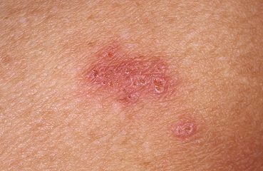 Герпес у взрослых: симптомы и лечение